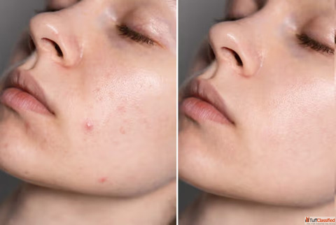 HydraFacial Treatment - Dermapuritys