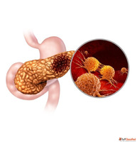 Best Treatment for Pancreatic Cancer in Mumbai by Experience...