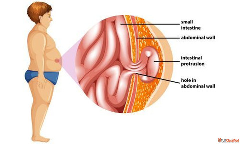 Laparoscopic Hernia Surgery in Kolkata