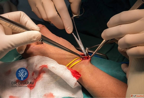 Best Dialysis Access AV Fistula Doctor in Mumbai-Dr. Dharav Kheradia