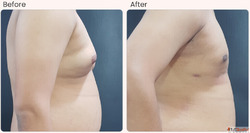 Gynecomastia Surgery Cost in Delhi - Dr Rajat Gupta