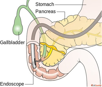 Reliable ERCP Treatment in Mumbai with Advanced Care