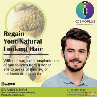 Expert Hair Transplant in Ahmedabad by Skilled Surgeons