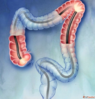 Best Colonoscopy in Mumbai for Accurate Diagnosis