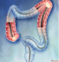 Best Colonoscopy in Mumbai for Accurate Diagnosis