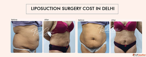 Liposuction Surgery Cost in Delhi What's Included and What's Not