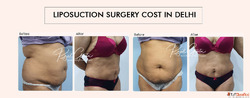 Liposuction Surgery Cost in Delhi What's Included and W...