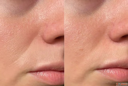 Genesis Facial - Dermapuritys