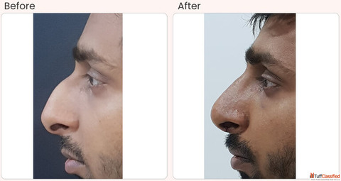 Nose surgery cost in Delhi - Dr Rajat Gupta