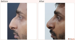 Nose surgery cost in Delhi - Dr Rajat Gupta