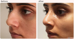 Rhinoplasty Surgery Before and After Real Results and What t...