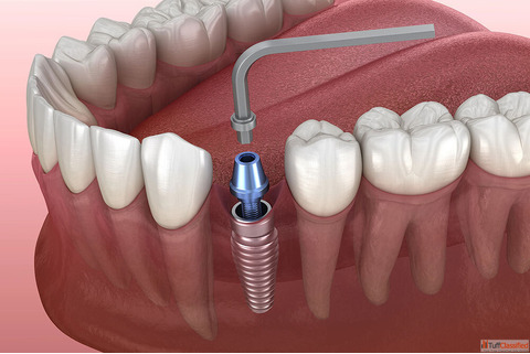 Trusted Implant Centre in Goa - Book Today