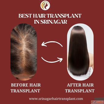 Best Hair Transplant Doctors in Srinagar for Natural and Safe Results
