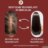 Best Hair Transplant Doctors in Srinagar for Natural and Saf...