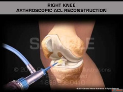 Arthroscopic Keyhole ACL Reconstruction by Experts