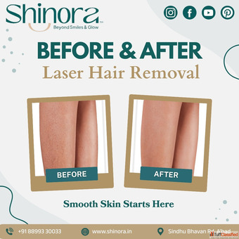 Shinora Clinic - Permanent Hair Reduction with Laser in Ahmedabad