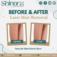 Shinora Clinic - Permanent Hair Reduction with Laser in Ahme...