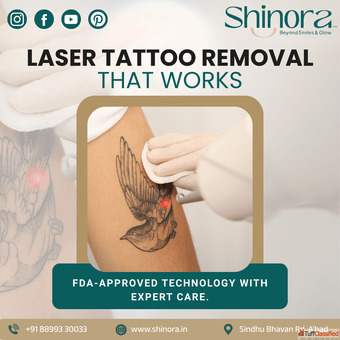 Laser Tattoo Removal in Ahmedabad - Shinora Clinic