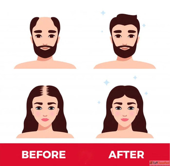 non surgical hair replacement