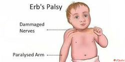 Treatment by Top Therapist for Erb's Palsy in Gurgaon P...