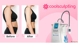 Chemical Peel Treatment in Delhi - Dermapuritys