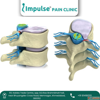 Reliable Sciatica Pain Treatment in Ahmedabad - Impulse Pain Clinic