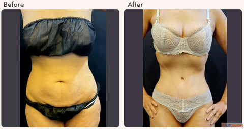Tummy Tuck Surgery in Delhi - Dr Rajat Gupta