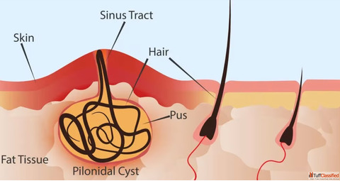 Pilonidal Sinus Treatment in Bangalore