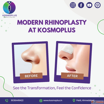 KosmoplusModern Rhinoplasty in Ahmedabad for Aesthetic Enhancement