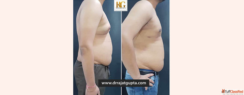 How is Scarless Gynecomastia Surgery Possible in India By Dr Rajat Gupta