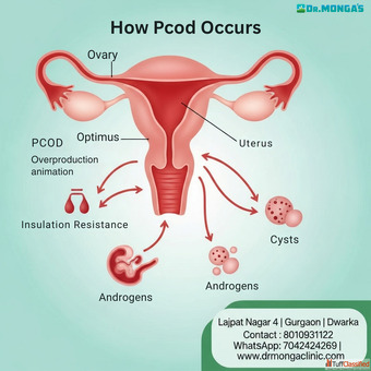 How PCOD Occurs In Lajpat Nagar Delhi 8010931122