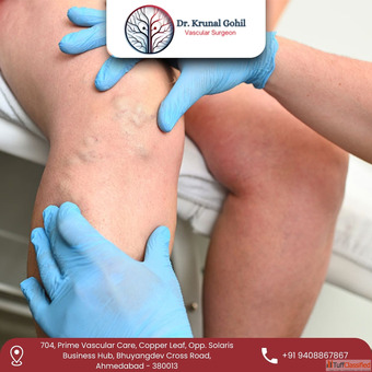 Best Varicose Veins Treatment in India by Dr.Krunal Gohil