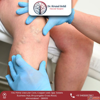 Best Varicose Veins Treatment in India by Dr.Krunal Gohil