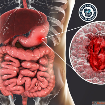 Dr. Harshad Joshi Offers the Best Peptic Ulcer Treatment in Mumbai