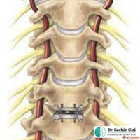 Slip Disc Surgery in Mumbai by Dr.Sachin Giri