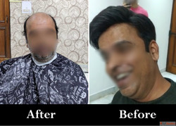 Adam's Secret - Best Hair Patch in Lucknow