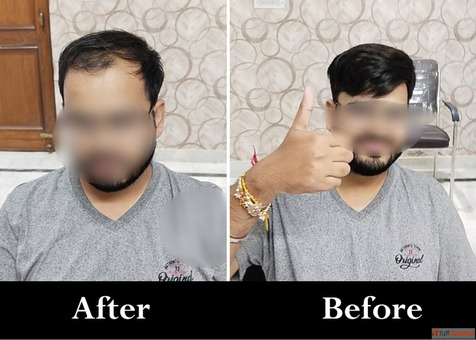 Adam's Secret - Best Hair Patch in Lucknow