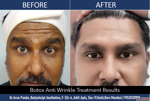 Expert Botox Buccal Fat Removal Services in Mumbai - Book Now