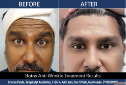 Expert Botox Buccal Fat Removal Services in Mumbai - Book No...