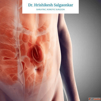 Best Hernia Surgeon in Mumbai India for Safe Advanced Treatment