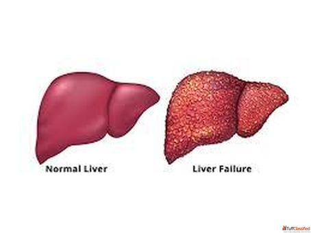 Treatment for Acute Liver Failure in Mumbai Care Focused on Patient Safety
