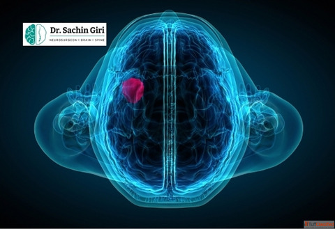 Advanced Brain Tumor Surgery in Mumbai by Dr. Sachin Giri