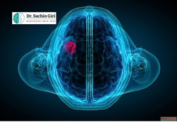 Advanced Brain Tumor Surgery in Mumbai by Dr. Sachin Giri