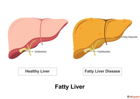 Advanced Fatty Liver Care in Mumbai Dr. Chetan Kalal