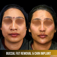 Affordable Chin Enhancement in Delhi - Trusted Chin Augmenta...