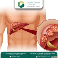 Expert Liver Cancer Treatment in Ahmedabad - Dr. Jenit Gandh...