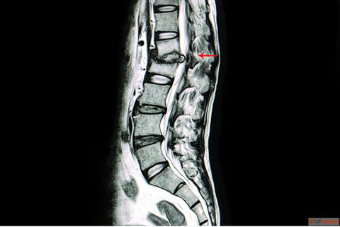 Tuberculosis Spine Surgery in Vizag - By Dr. B. Leela Prasad