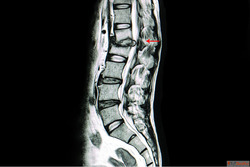 Tuberculosis Spine Surgery in Vizag - By Dr. B. Leela Prasad