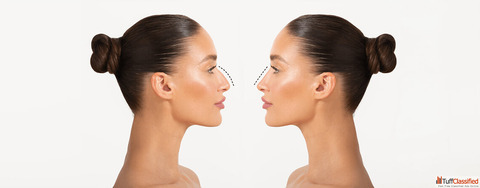 Rhinoplasty Surgery 101 What You Need to Know About Nose Reshaping