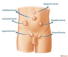 Hernia Surgery in South Delhi